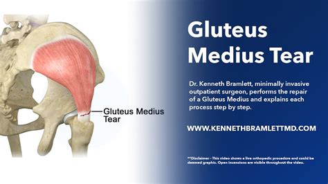 gluteus medius tears reviews